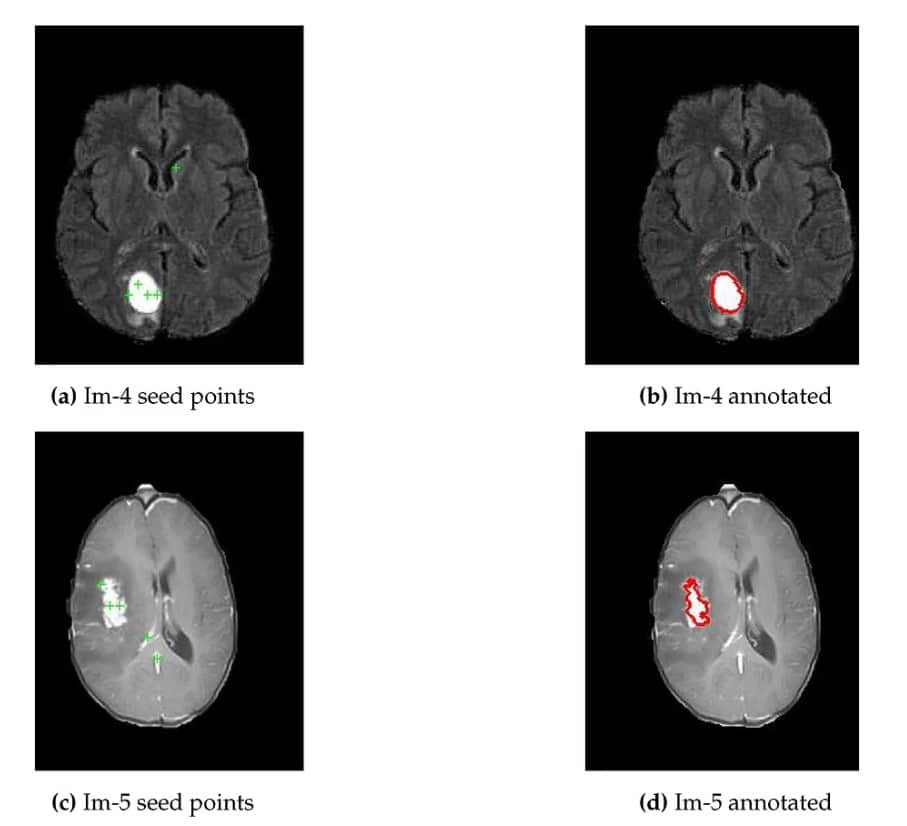 Top Image Segmentation Methods for Machine Vision 3 Tumor identification with segmentation methods